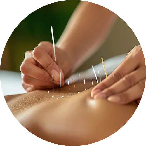 Acupuncture